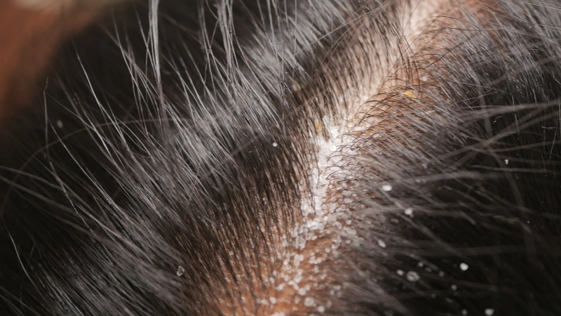 Sử dụng dầu gội trị vảy nến chứa Axit Salicylic