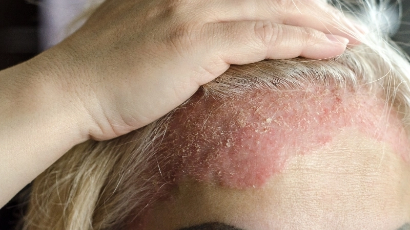 Thuốc bôi vảy nến da đầu chứa Corticosteroid theo chỉ định