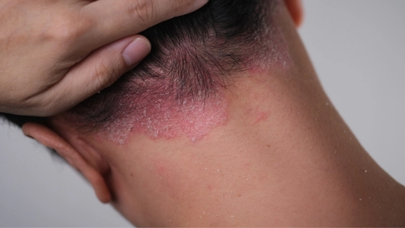 Stress là một trong những nguyên nhân bệnh vảy nến da đầu bùng phát phổ biến.