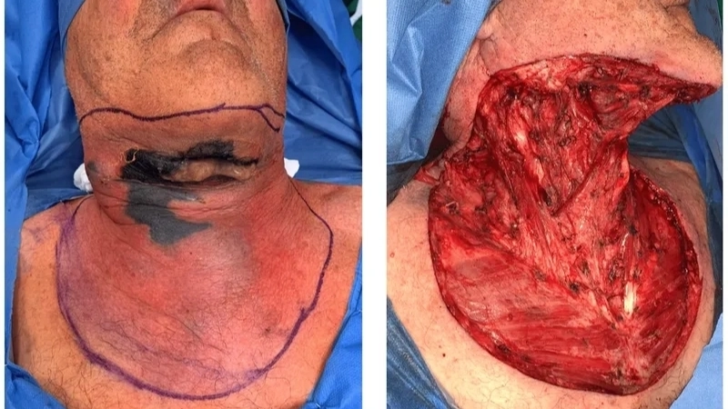 Minh họa cách điều trị vi khuẩn ăn thịt người