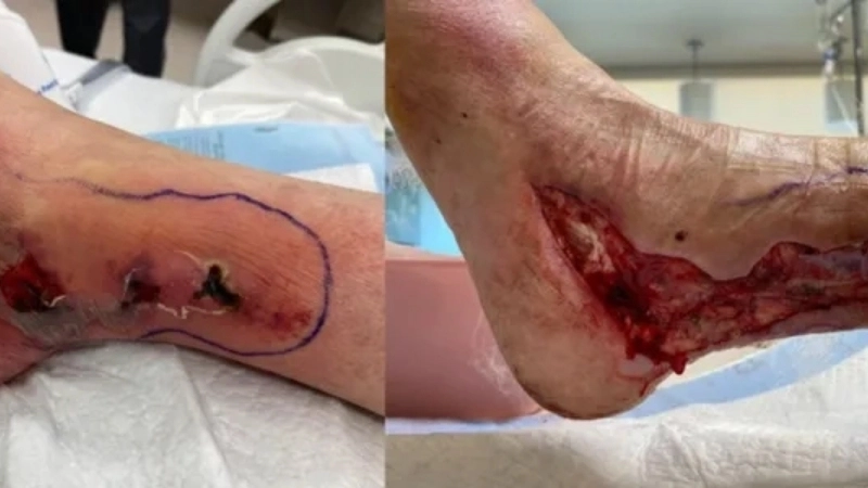 Giải đáp bệnh vi khuẩn ăn thịt người có chữa được không