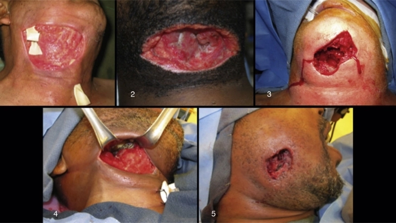 Tiến triển nhanh chóng của bệnh qua từng giai đoạn