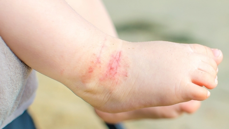 Hình ảnh viêm da cơ địa người trẻ sơ sinh