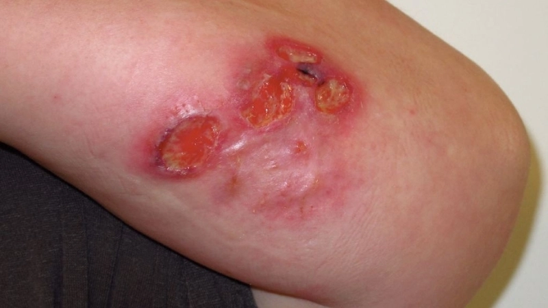 Tổng hợp các ảnh viêm da có dấu hiệu nhiễm trùng thứ phát