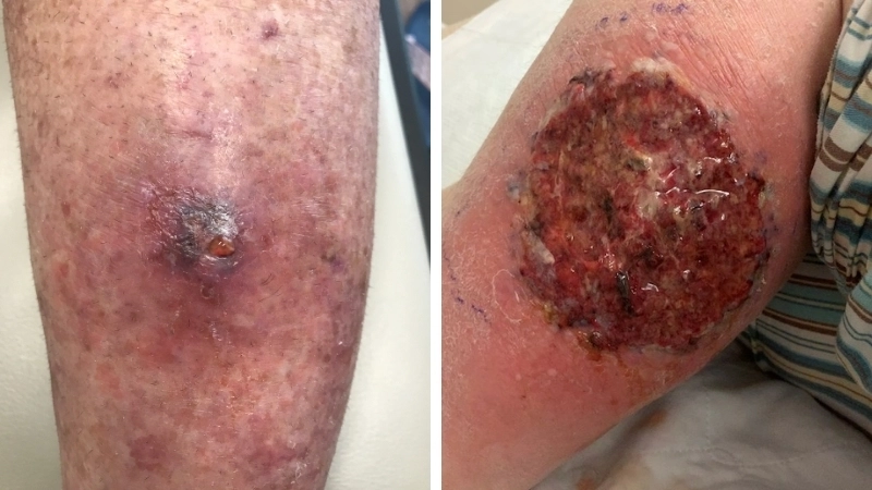 Cận cảnh hình ảnh bị viêm da do nhiễm trùng tụ cầu khuẩn