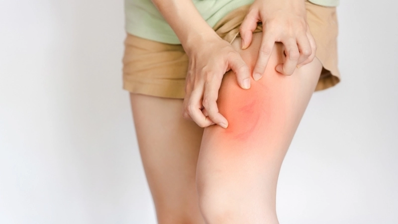 Biến chứng thận làm rõ viêm mao mạch dị ứng có nguy hiểm không