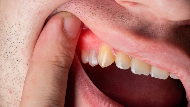 Sử dụng nước súc miệng trị viêm nướu đúng cách