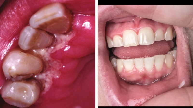 Top những hình ảnh về các cấp độ của bệnh viêm nướu