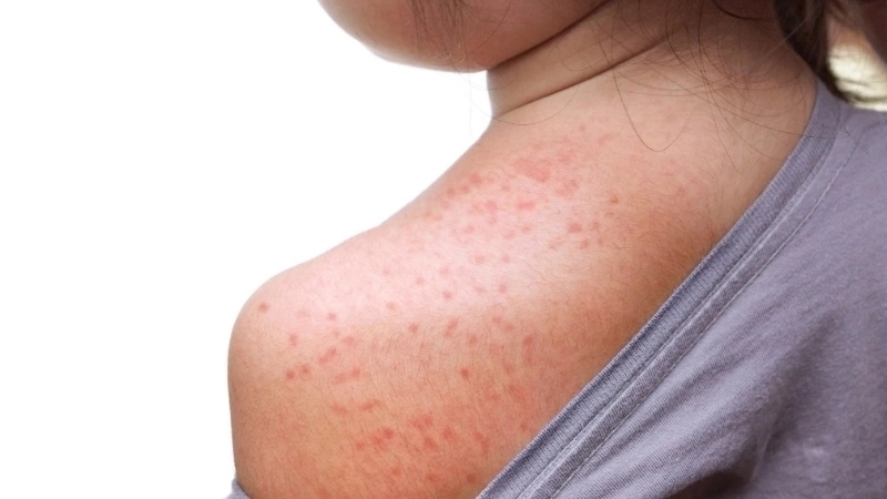 Hình ảnh bé bị sởi khi các nốt ban xuất hiện