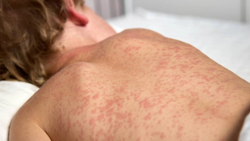 Bệnh sởi Hình ảnh lâm sàng điển hình