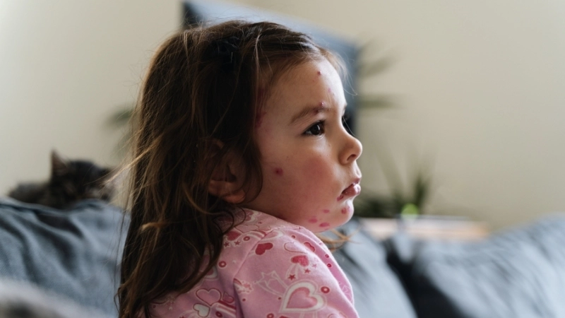 Hình ảnh của bệnh sởi ở trẻ em