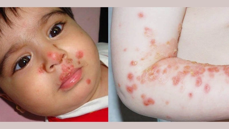 Thông tin cơ bản về bệnh đậu mùa khỉ