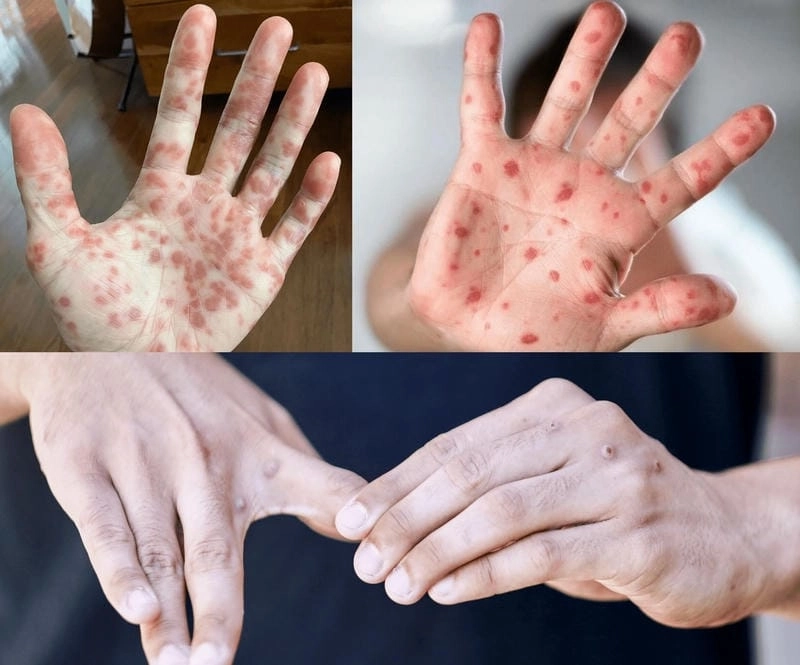 Hình ảnh người bị bệnh đậu mùa khỉ thực tế
