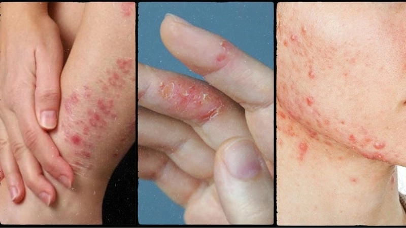 Cách chăm sóc da mặt khi bị eczema an toàn