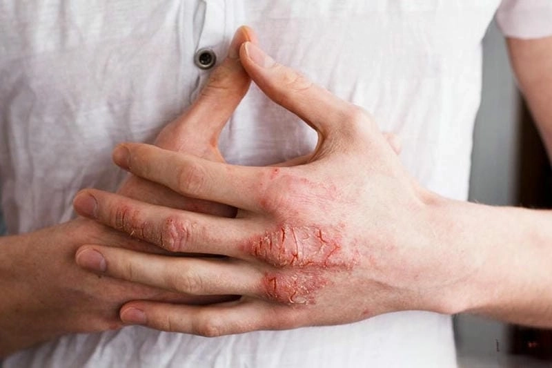 Thông tin nhận biết và chăm sóc eczema cơ bản