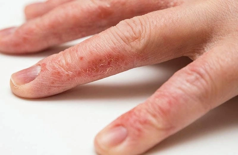 Kiến thức tổng quan về bệnh chàm eczema da