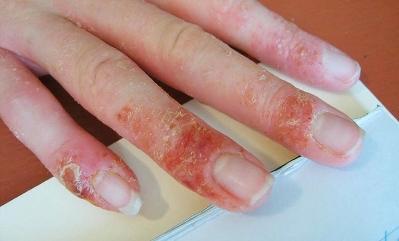 Nhận biết eczema tiếp xúc và phòng ngừa tái phát
