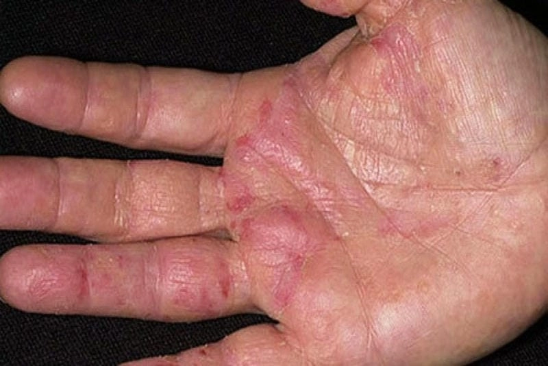 Hình ảnh bệnh eczema ở người dễ nhận biết
