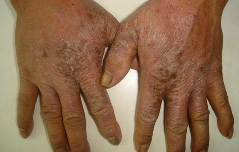 Cách chăm sóc và bảo vệ da khi bị eczema