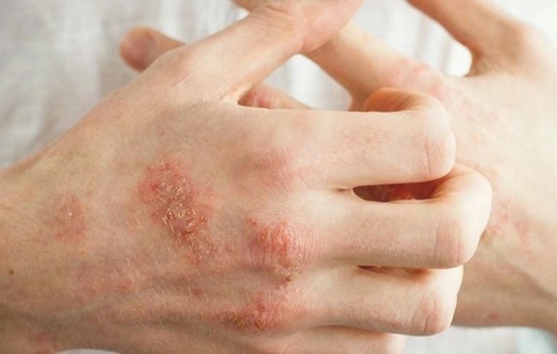 Khám phá ảnh bệnh eczema ấn tượng giúp nhận biết nhanh