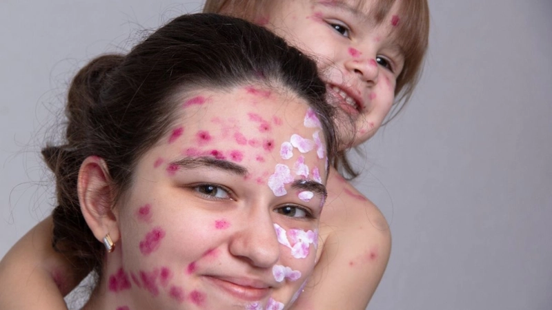 Dấu hiệu thường gặp của nấm da mặt điển hình