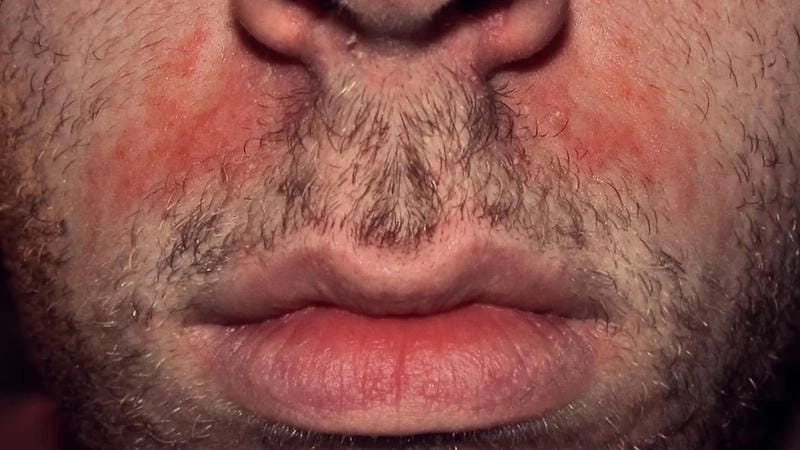 Hình ảnh người bị bệnh nấm da mặt thật rõ nét