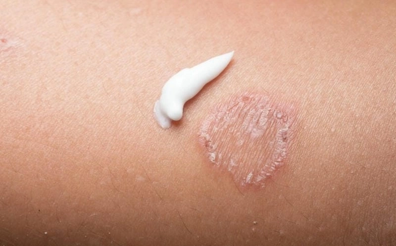 Nấm mặt ở trẻ em cần được chú ý sớm kịp thời