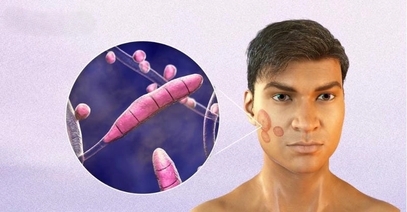 Nấm trên da mặt gây ngứa và bong tróc khó chịu