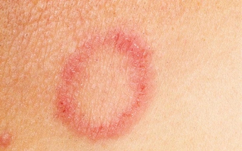 Trẻ bị nấm da mặt cần chăm sóc đúng cách