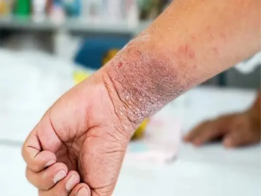 Cập nhật hình ảnh bệnh eczema cùng phương pháp điều trị