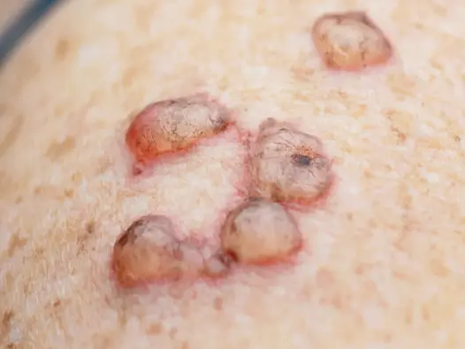 Hình ảnh bệnh hạ cam thực tế giúp nhận biết sớm dấu hiệu