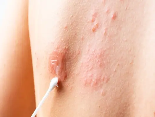 Hình ảnh bệnh herpes và các cụm mụn nước ở môi và sinh dục