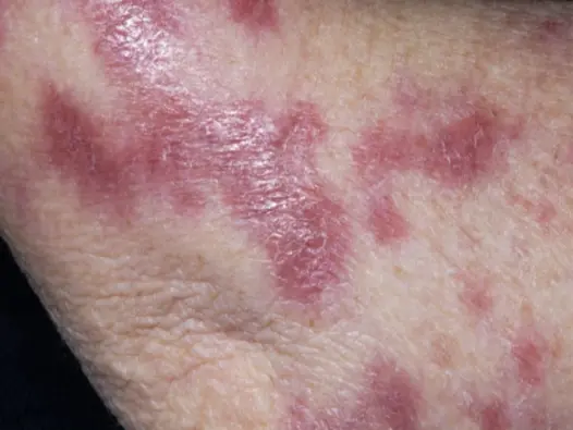 Hình ảnh bệnh lao da và dấu hiệu sớm dễ bị nhầm lẫn