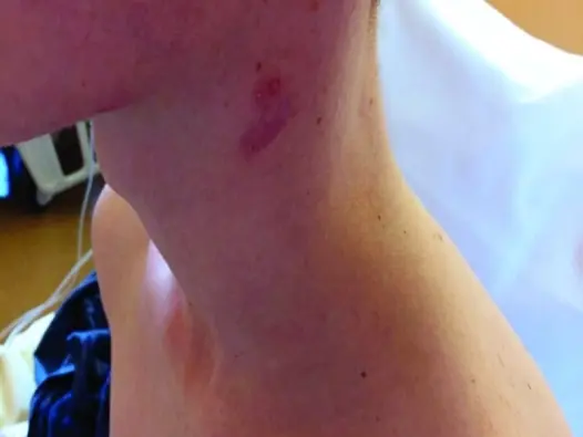 Hình ảnh bệnh lao hạch - Cách phân biệt với các loại u hạch