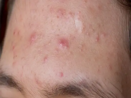 Hình ảnh bệnh mụn trứng cá - Nhận biết các loại mụn thường gặp