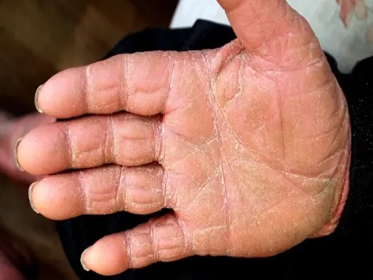 Hình ảnh bệnh nấm da tay - Dấu hiệu và cách điều trị