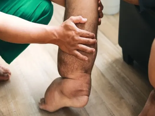 Hình ảnh bệnh phù chân voi qua từng giai đoạn phát triển