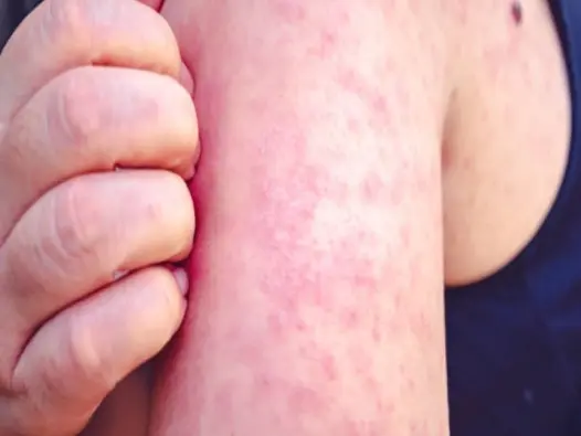 Hình ảnh bệnh rubella và các nốt ban hồng đặc trưng ở trẻ