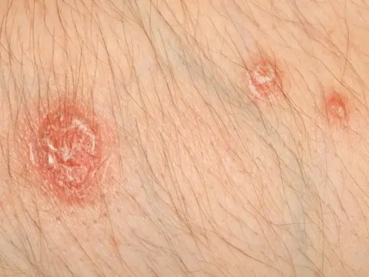 Hình ảnh bệnh vảy phấn hồng - Nhận biết để trị đúng