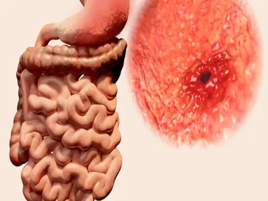 Hình ảnh bệnh viêm loét dạ dày - Các ổ loét qua ảnh nội soi
