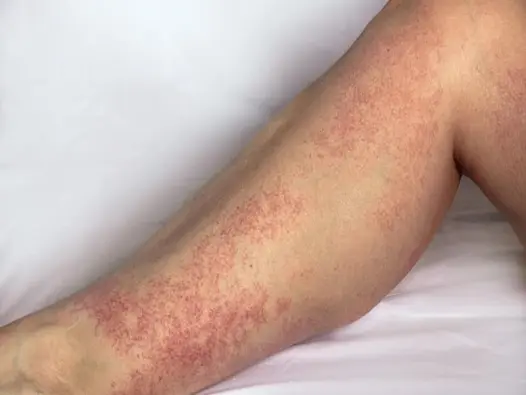 Hình ảnh bệnh viêm mao mạch dị ứng ở trẻ em và người lớn