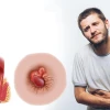 Bệnh trĩ dấu hiệu nhận biết sớm và các bước điều trị hiệu quả