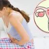 Dấu hiệu nhận biết sớm ung thư cổ tử cung