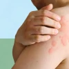 Hình ảnh bệnh phong ngứa và những điều cần biết
