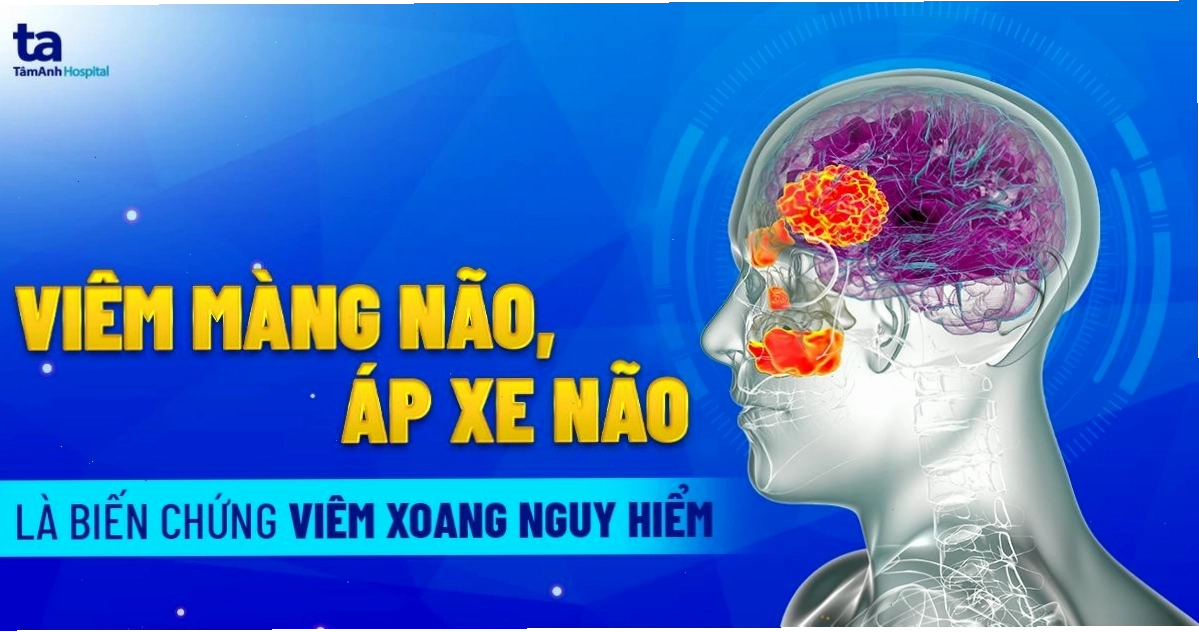 8 Biến chứng viêm xoang thường gặp và những nguy hiểm khôn lường