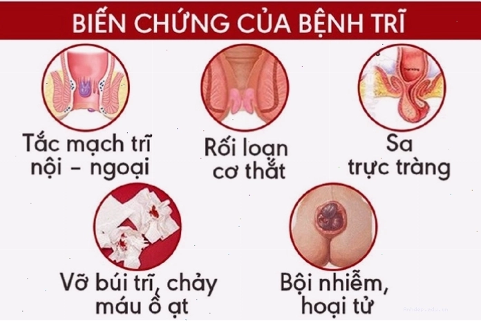 Bác sĩ tư vấn cho bệnh nhân về dấu hiệu bệnh trĩ