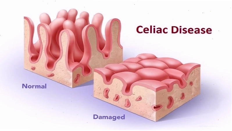 Bệnh Celiac gây tiêu chảy kéo dài