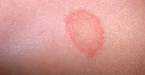 Bệnh lác đồng tiền nguyên nhân, triệu chứng và cách điều trị hiệu quả