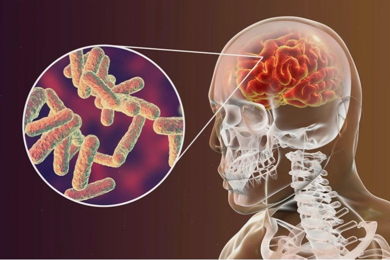 Bệnh lao màng não thời kỳ khởi phát có triệu chứng không điển hình dễ bị bỏ qua.