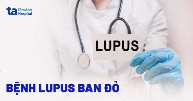 Bệnh lupus ban đỏ có thể ảnh hưởng đến khớp ngón tay